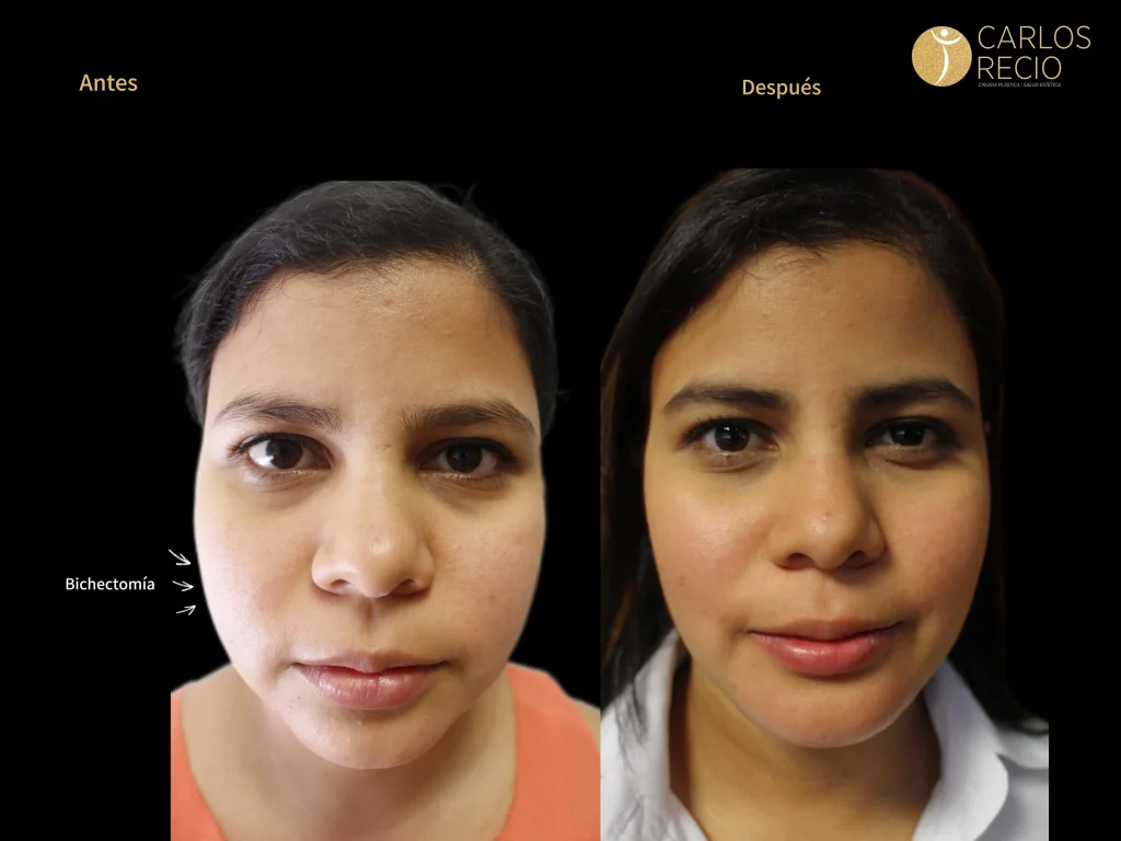 Bichectomía para una cara más definida Bichectomía para una cara más definida